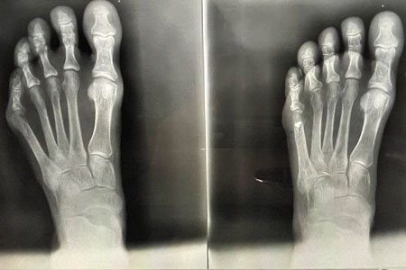 buionette/tailor’s bunion correction