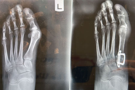 lapiasty 3d bunion correction