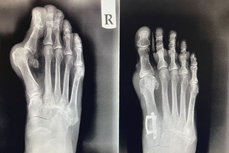 lapiasty 3d bunion correction