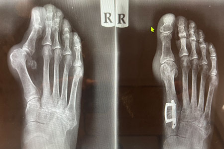 lapiasty 3d bunion correction