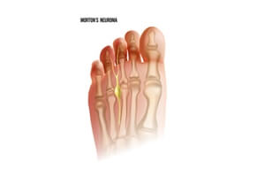 Common Symptoms of Morton&#039;s Neuroma