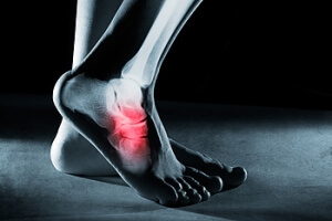 How Foot Stress Fractures are Diagnosed