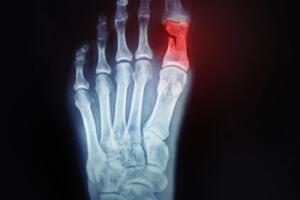 Taking Care of a Broken Toe