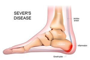 Insights Into Definition and Causes of Sever’s Disease